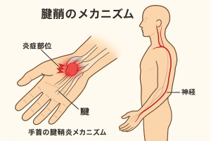 腱鞘炎のメカニズム