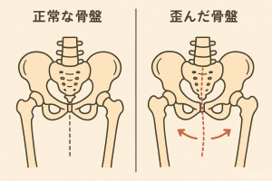 骨盤のゆがみ